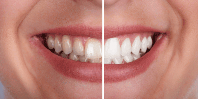 teeth whitening dentist