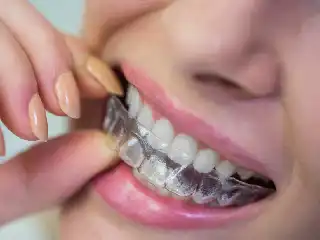 SureSmile Clear Aligners