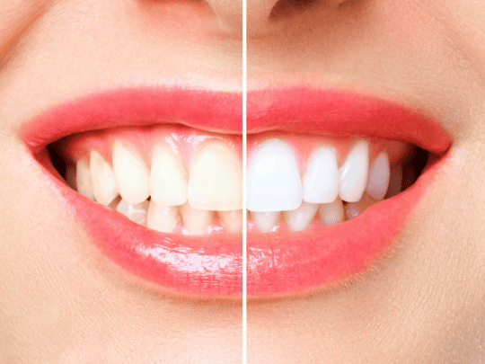 teeth whitening